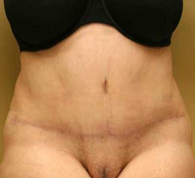 Tummy Tuck