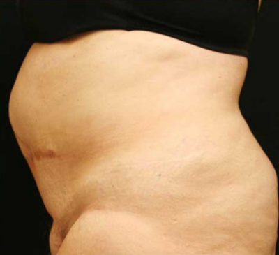 Tummy Tuck