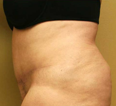 Tummy Tuck