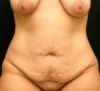 Tummy Tuck
