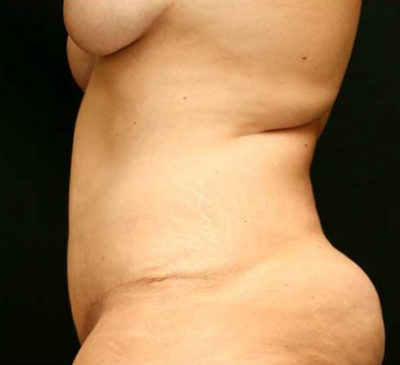 Tummy Tuck