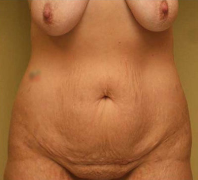 Tummy Tuck