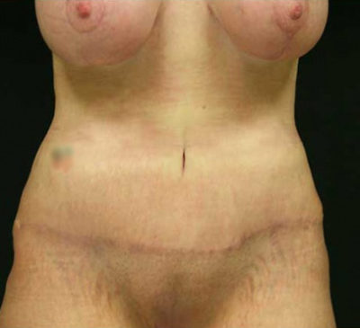 Tummy Tuck