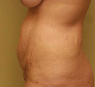 Tummy Tuck