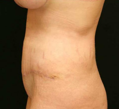 Tummy Tuck