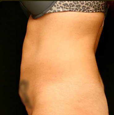 Tummy Tuck