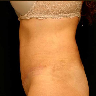 Tummy Tuck