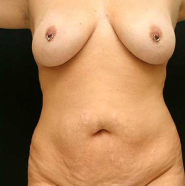 Tummy Tuck