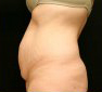 Tummy Tuck
