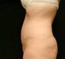Tummy Tuck