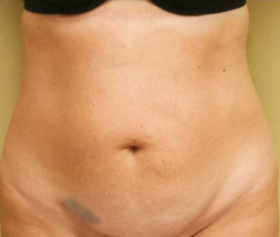 Tummy Tuck