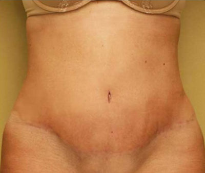 Tummy Tuck