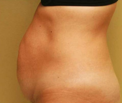 Tummy Tuck