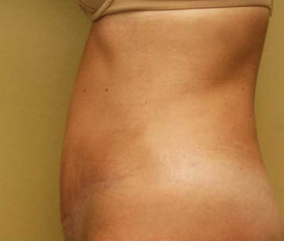 Tummy Tuck