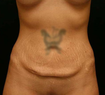 Tummy Tuck