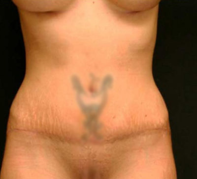 Tummy Tuck