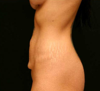 Tummy Tuck
