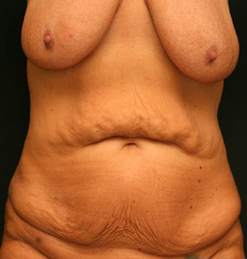 Tummy Tuck