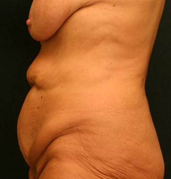 Tummy Tuck