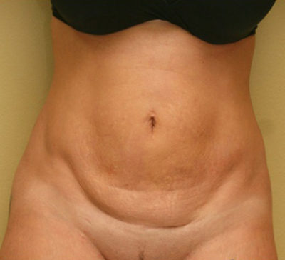 Tummy Tuck