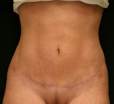 Tummy Tuck