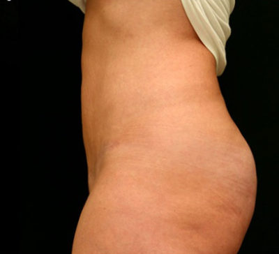 Tummy Tuck