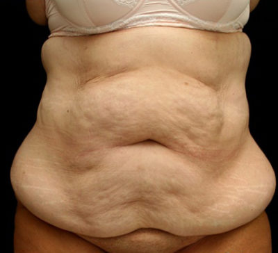 Tummy Tuck