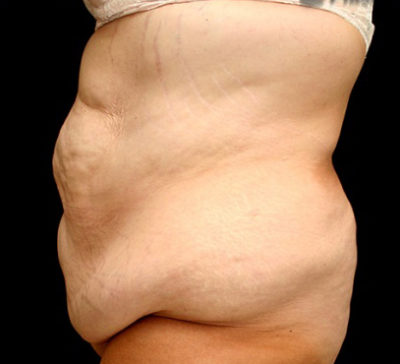 Tummy Tuck