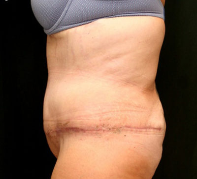 Tummy Tuck