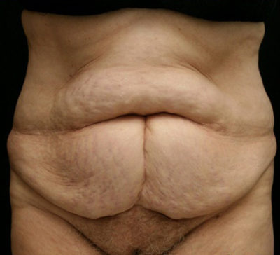 Tummy Tuck