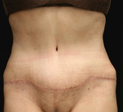 Tummy Tuck
