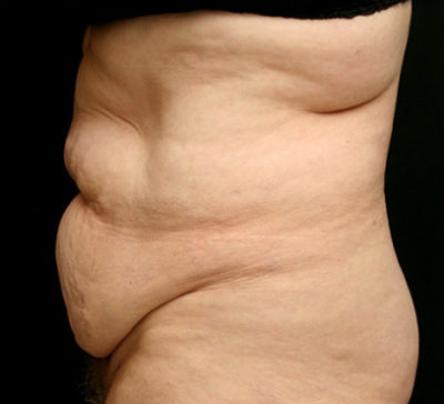 Tummy Tuck