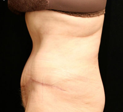 Tummy Tuck