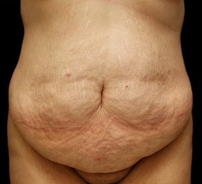 Tummy Tuck