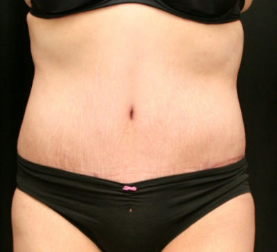 Tummy Tuck