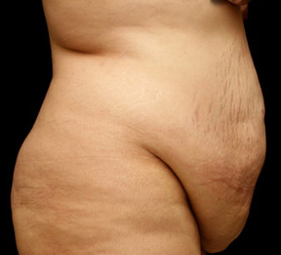 Tummy Tuck