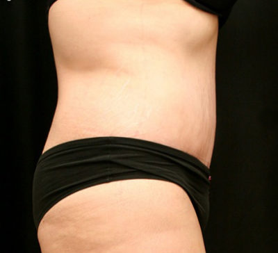 Tummy Tuck