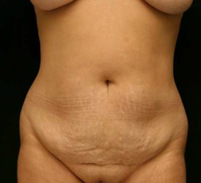 Tummy Tuck