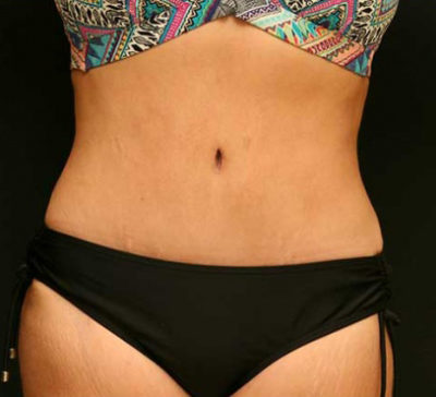 Tummy Tuck