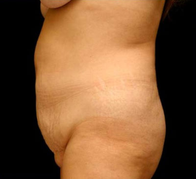 Tummy Tuck
