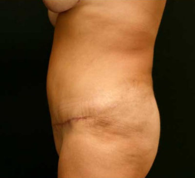 Tummy Tuck
