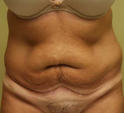 Tummy Tuck