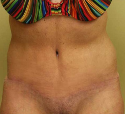 Tummy Tuck