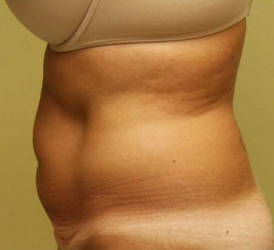 Tummy Tuck