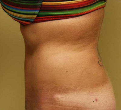 Tummy Tuck