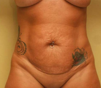 Tummy Tuck
