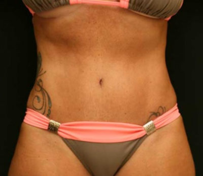 Tummy Tuck