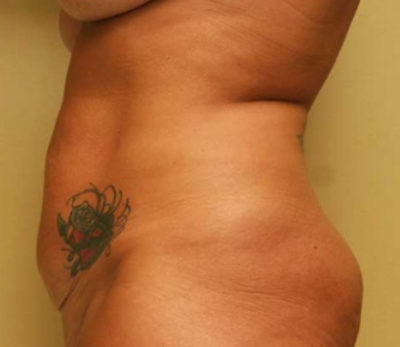 Tummy Tuck