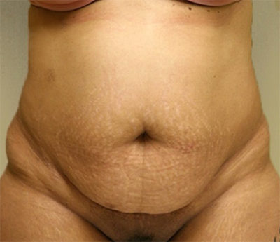 Tummy Tuck