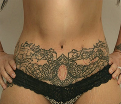 Tummy Tuck